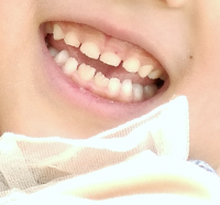 子供の歯